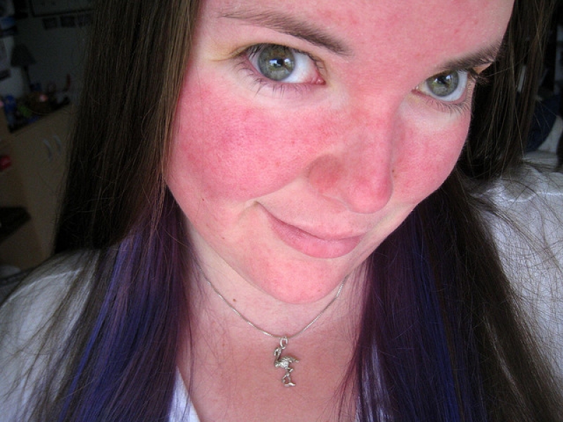 What is rosacea?